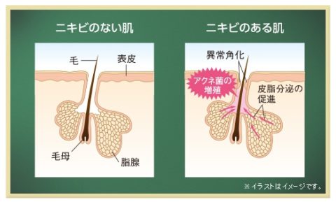 ファーストクラッシュニキビ肌モデル